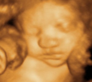 3D / 4D  Ultrasound Image