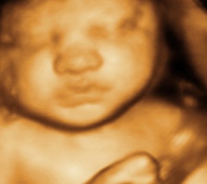 3D / 4D  Ultrasound Image