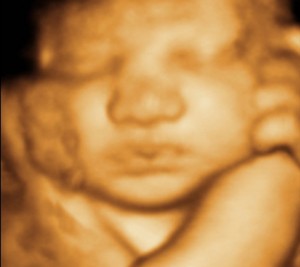 3D / 4D  Ultrasound Image