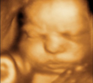 3D / 4D  Ultrasound Image